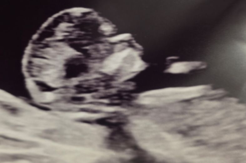 Ultrasound Image